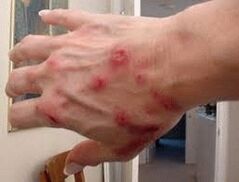 The skin on the skin with helminths