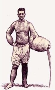 A patient with elephantiasis